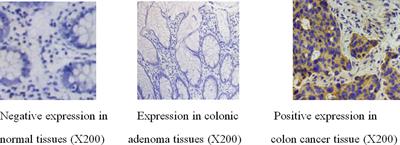 Wnt7a Promotes the Occurrence and Development of Colorectal Adenocarcinoma